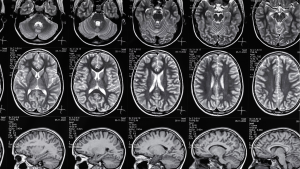 different types of aphasia